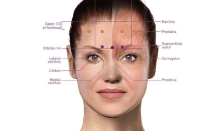Botox For Migraine
