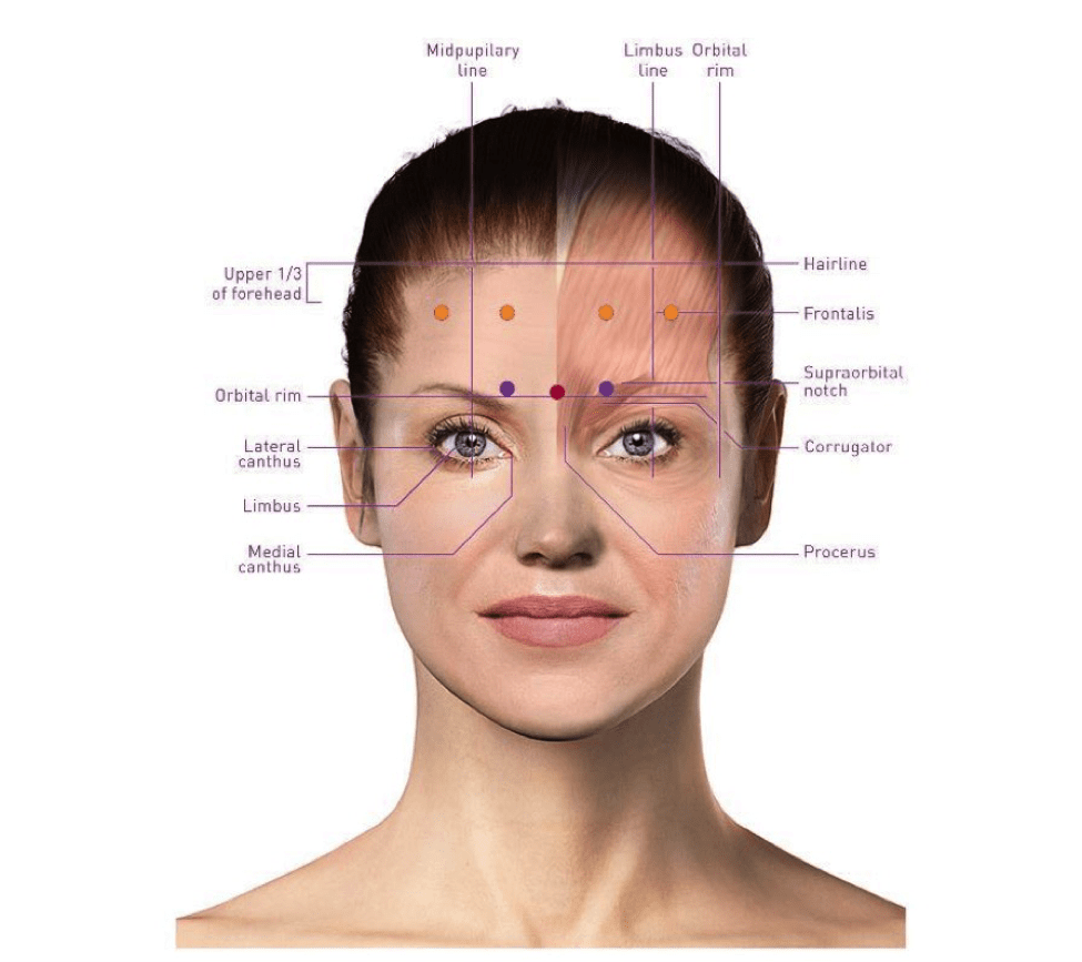 Botox Injections For Migraines